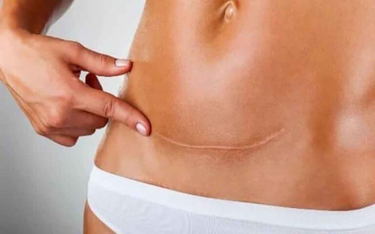 Chirurgie ventre après césarienne est-ce possible